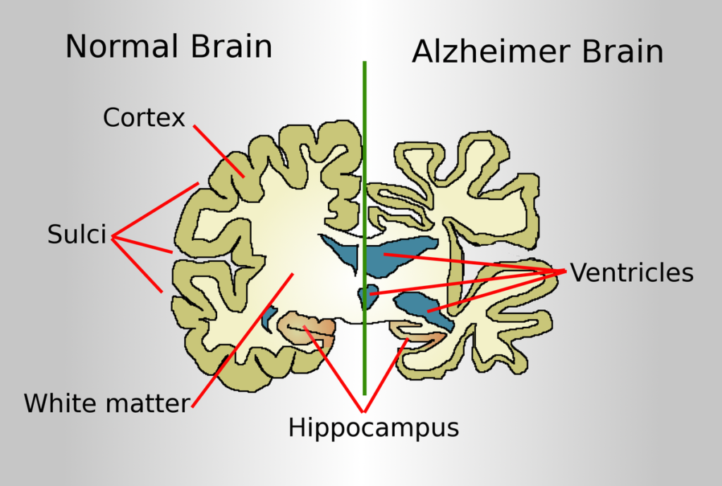 alzheimer Best Multispeciality Hospital for Alzheimer's Disease