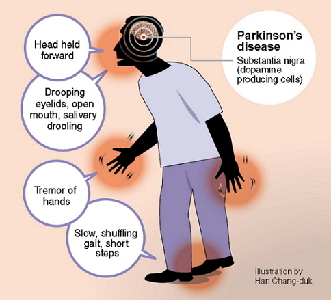 Parkinson best multispecialty hospital for Parkinson's disease