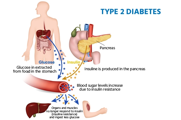 diabetes diabetes
