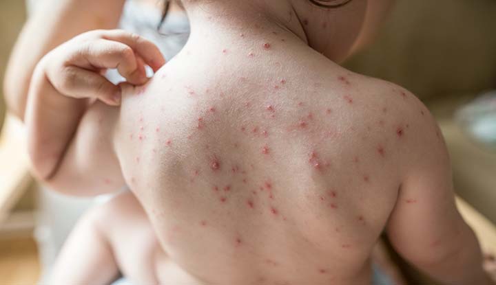 Chickenpox Chickenpox