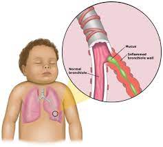 Bronchiolitis Bronchiolitis