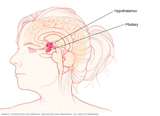 Pituitary Tumors Pituitary Tumors