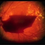 Diabetic-Retinopathy
