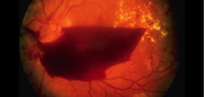 Diabetic-Retinopathy